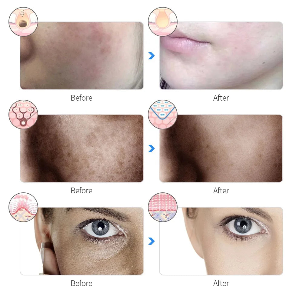 RadiantSkin Home LED Therapy Mask